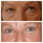 Eye Bag removal
