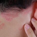 Can a dermatologist treat scalp eczema painlessly
