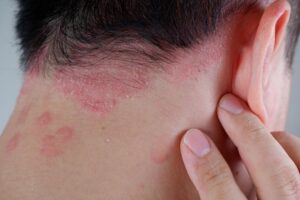 Can a dermatologist treat scalp eczema painlessly