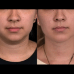 Double chin removal