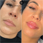 Dermal Fillers