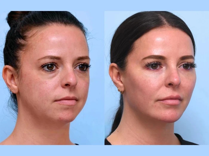 Experience Instant Results with Thread Lift at the Best Aesthetic Clinics in Dubai
