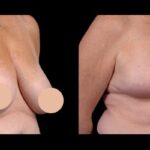 breast reduction in dubai