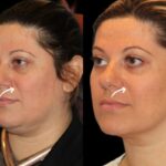 H7-Sculptra