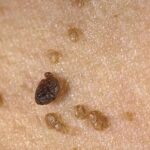 How to Remove Skin Tags on the Inner Thigh: Follow These Safe Steps