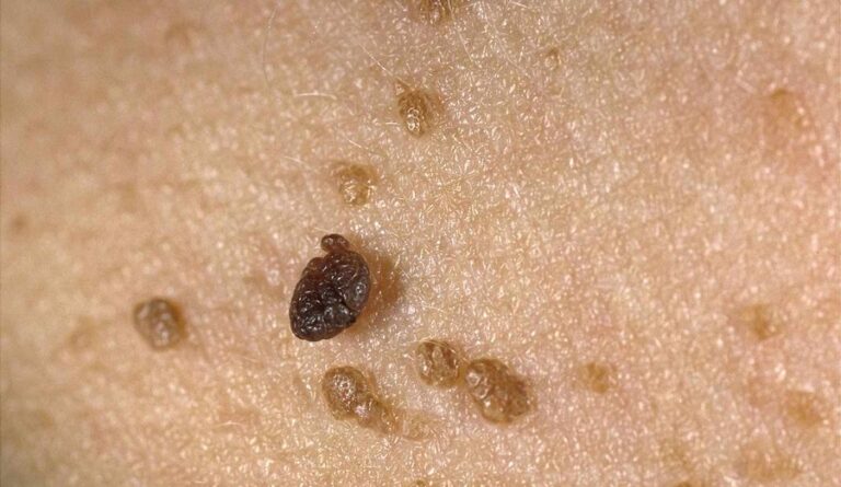How to Remove Skin Tags on the Inner Thigh: Follow These Safe Steps