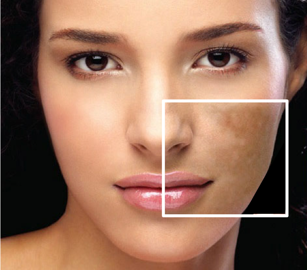 Pigmentation Treatment The Latest Advances in Skincare Tech