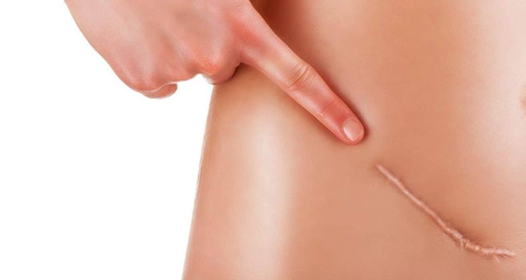 Renew Beauty Naturally with Surgical Scar Revision