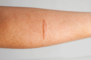 Surgical Scar Revision: Beautiful Skin Restored