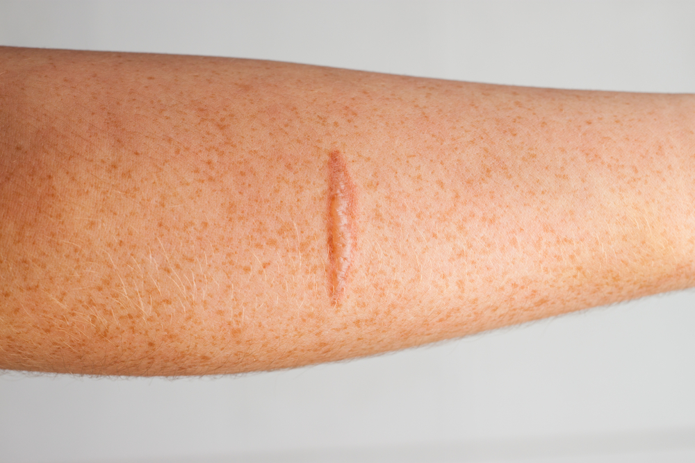 Surgical Scar Revision: Beautiful Skin Restored