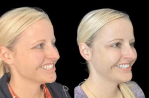 Restore Your Confidence with Botox in Dubai