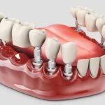 fixed dentures 