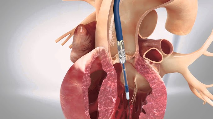 TAVI Expert in Jaipur