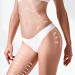 Fat transfer in dubai