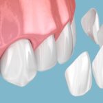 Dental Veneers Before & After: How Dubai Clinics Excel