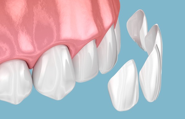 Dental Veneers Before & After: How Dubai Clinics Excel