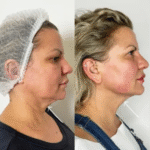 Endolift in Dubai – A Revolutionary Skin Tightening Solution