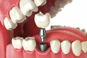 Smart Planning for Dental Implants Using