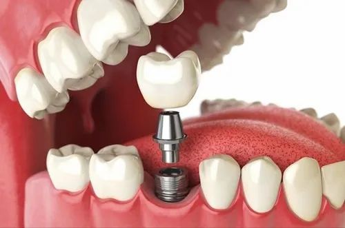 Smart Planning for Dental Implants Using