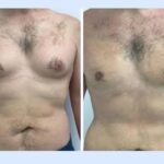 gynecomastia in dubai (1) (1) (1) (1)