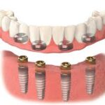 https://thedenturecompany.com/implant-supported-dentures/