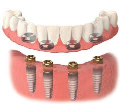 https://thedenturecompany.com/implant-supported-dentures/
