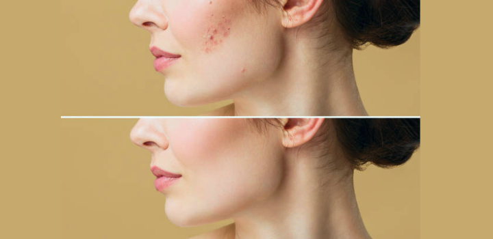 acne treatment near me