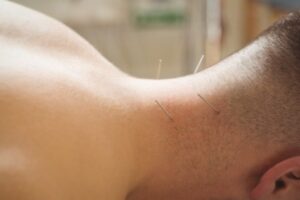 Acupuncture Perth