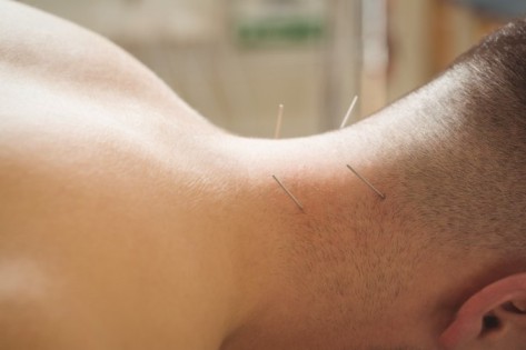 Acupuncture Perth