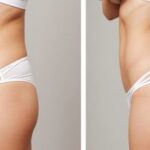 butt fat transfer in dubai