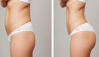 butt fat transfer in dubai