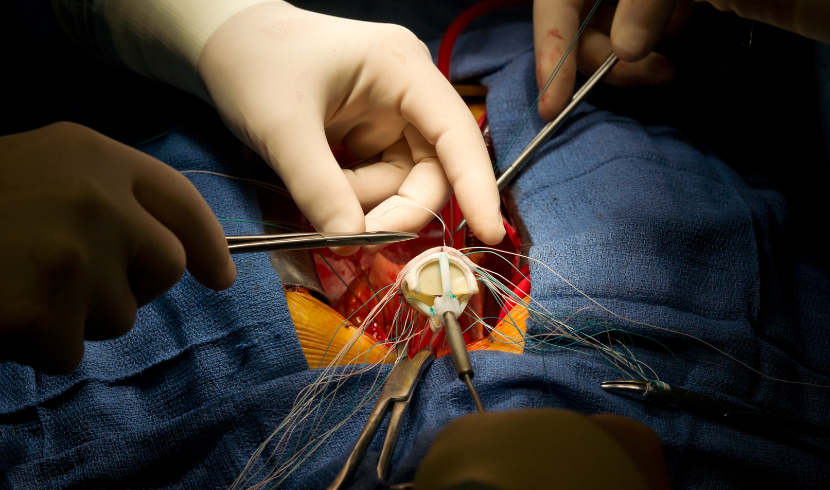 Aortic Valve Replacement Devices Market (1)