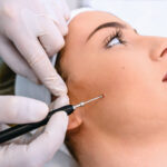 Birthmark Treatment Cost and Results