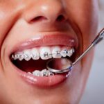 Choosing the Right Dental Braces in Dubai