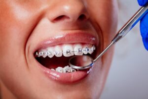 Choosing the Right Dental Braces in Dubai