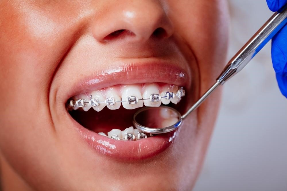 Choosing the Right Dental Braces in Dubai