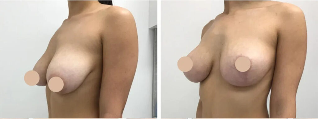 H18-Breast-reduction