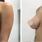 H18-Breast-reduction