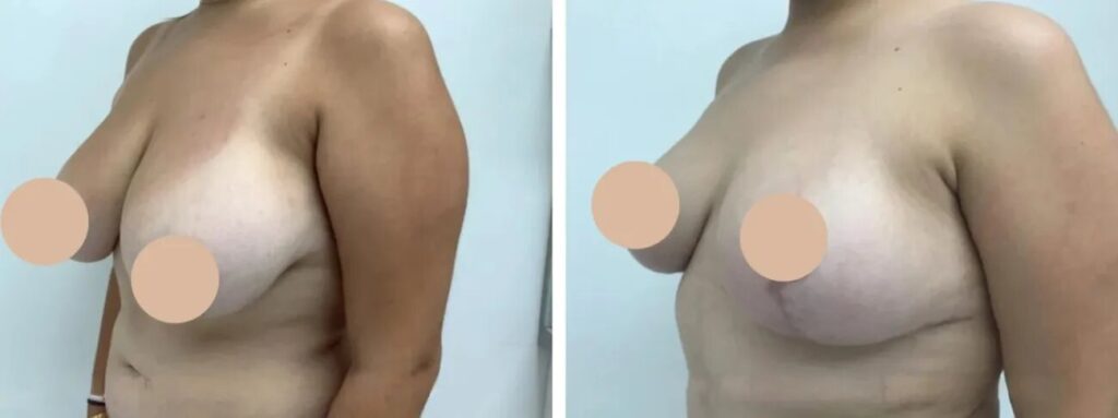 H34-Breast-Lift