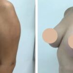 H34-Breast-Lift