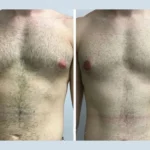 Gynecomastia in Dubai: What Makes It Unique
