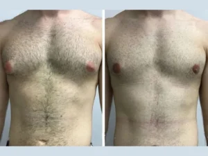 Best Gynecomastia Surgeons in Dubai: How to Maintain Results Long-Term