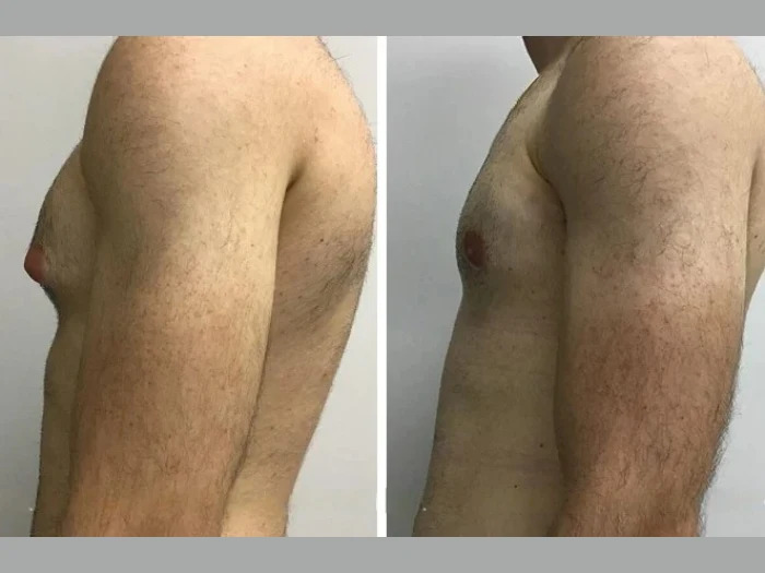 H9-Gynecomastia
