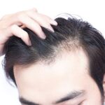 Hair Transplantation in Dubai: Before and After Care