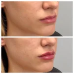 Best treatment for undereyes Chicago