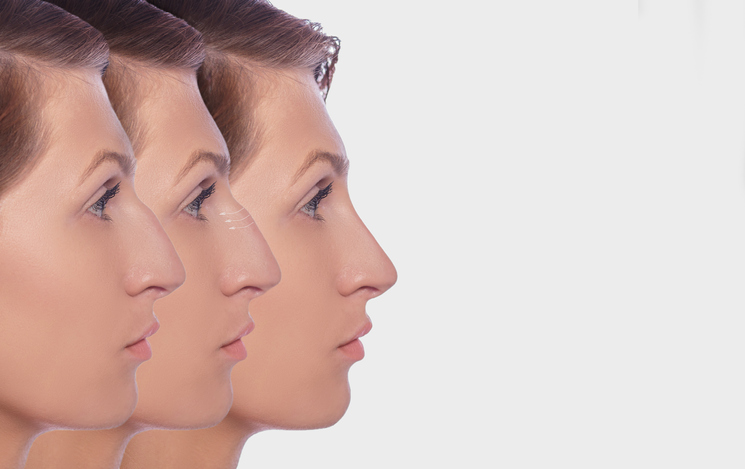 Latest Rhinoplasty Trends in Dubai 2025