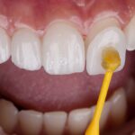 Composite Veneers Dubai: Affordable Cosmetic Option
