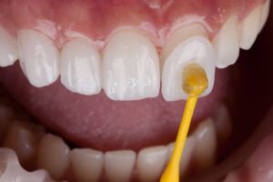 Composite Veneers Dubai: Affordable Cosmetic Option