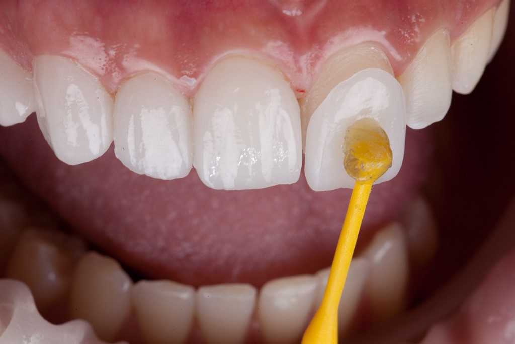 Composite Veneers Dubai: Affordable Cosmetic Option