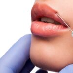 Lip Filler